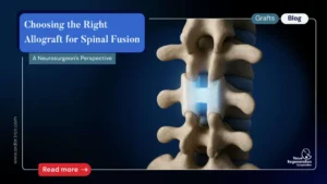 allograft for spinal fusion