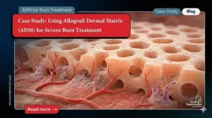 ADM for Severe Burn Treatment
